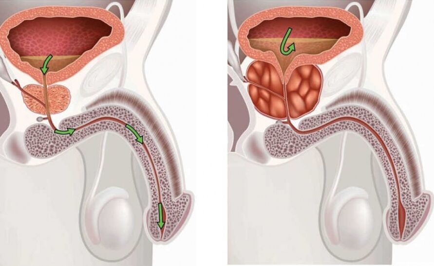 Informacije o bolezni prostatitis